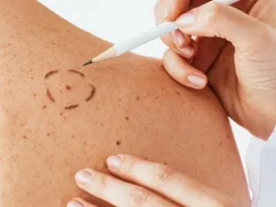 banner skincancer