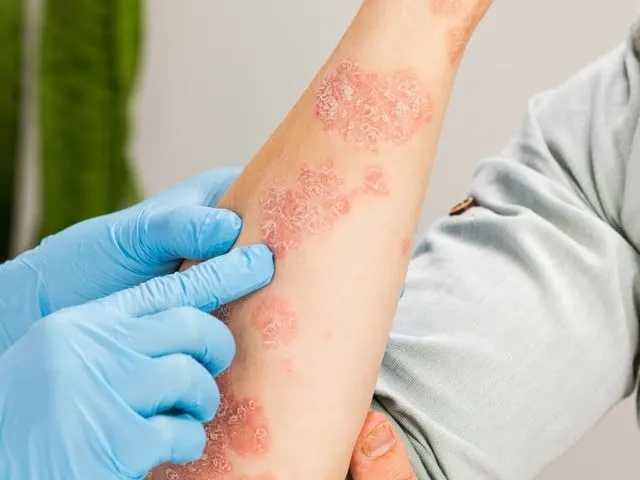 A dermatologist wearing gloves examines the skin of a sick patient