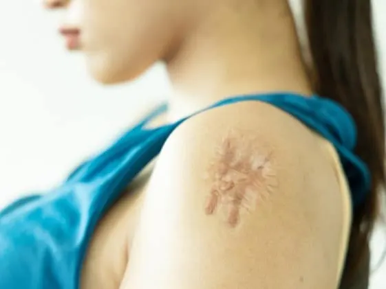 hypertrophic scars