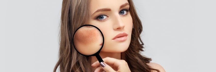 banner melasma